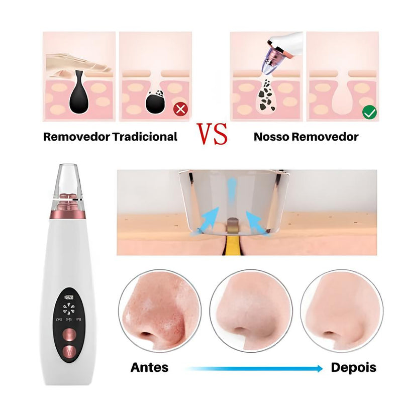 Removedor de Cravos, Acne e Hidratante - Pore Vaccum